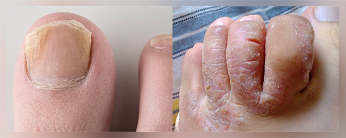Преимущества пасты Теймурова при лечении грибка ногтей