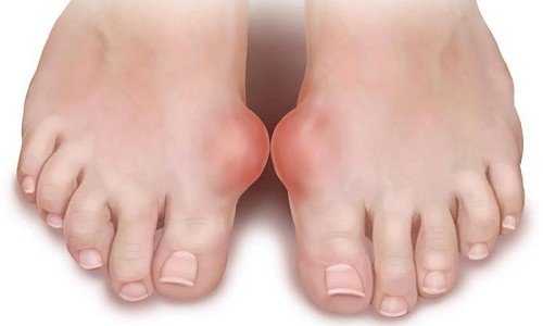 Симптомы и лечение артрита пальцев ног