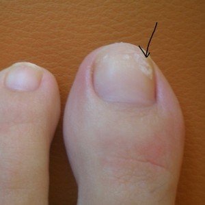 На ногте большого пальца ноги образовалось темное пятно?