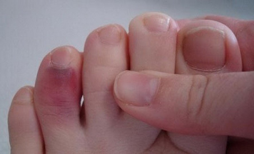Отличия перелома от ушиба пальца на ноге