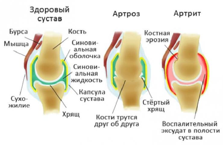 Составление рациона при артрите коленного сустава