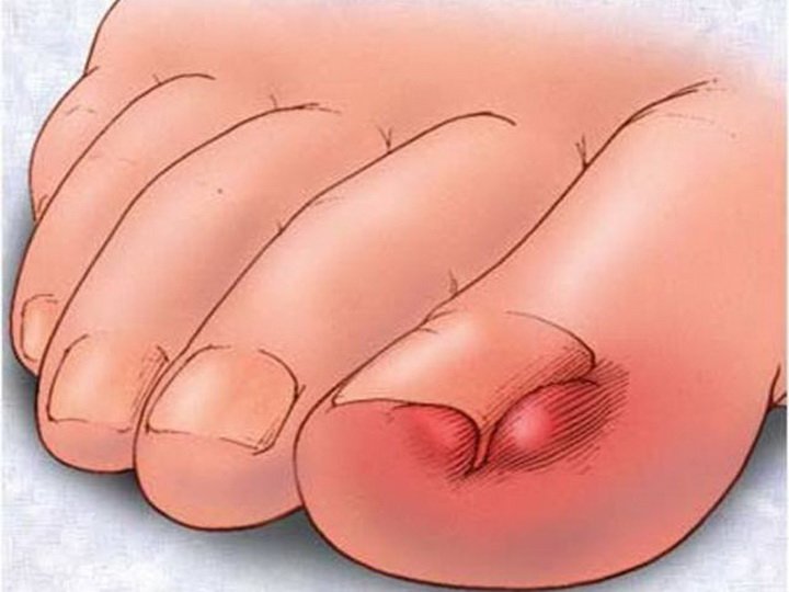 Что делать, если палец на ноге опух и болит?