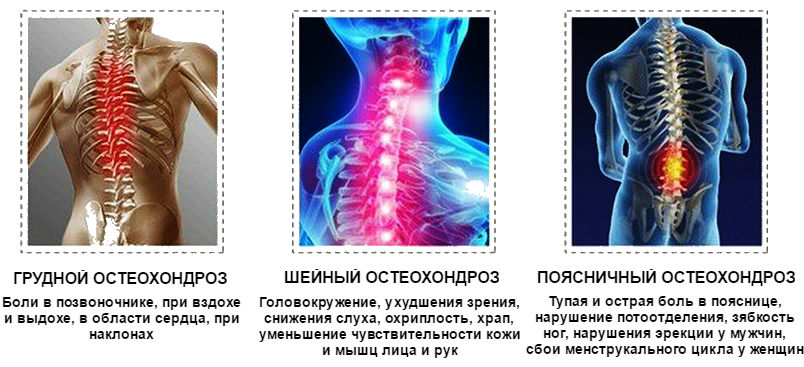 Грудной, шейный и поясничный остеохондроз