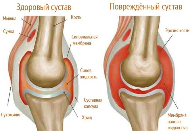 Как лечить отложение солей в коленях?