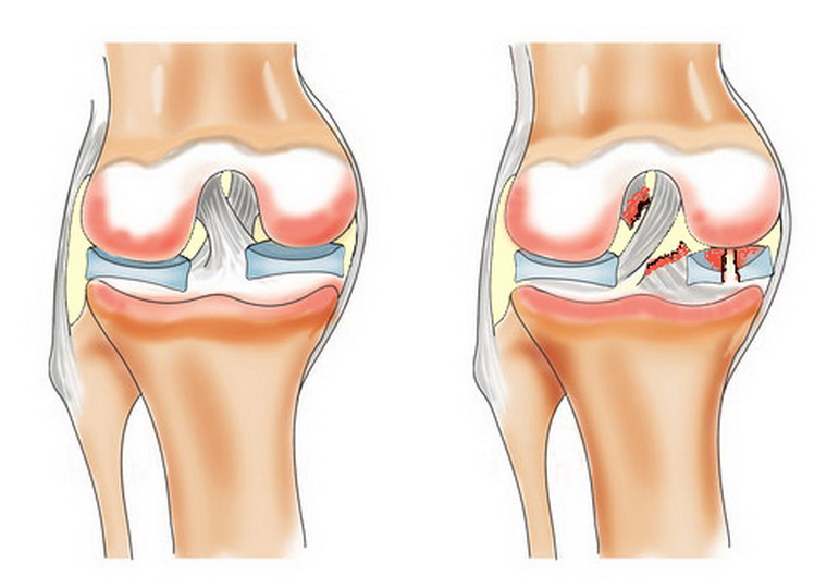 Виды разрыва крестообразной связки коленного сустава, лечение и реабилитация
