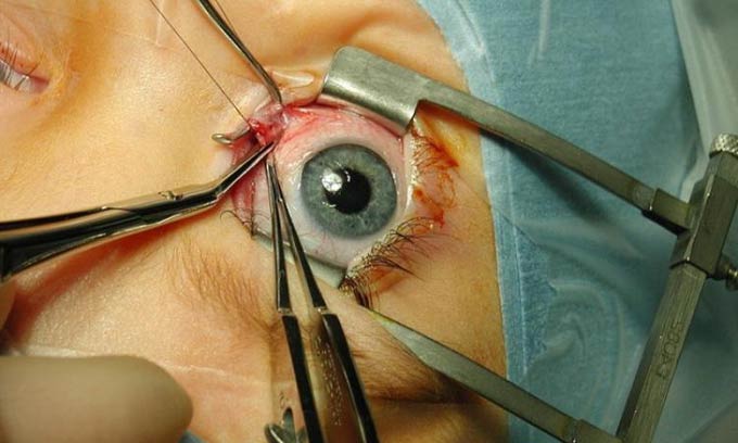 реабилитация после операции на глазах