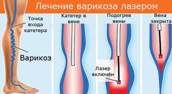 Особенности проведения флебэктомии вен на ногах
