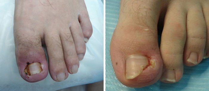 Лазерное удаление вросшего ногтя на большом пальце ноги