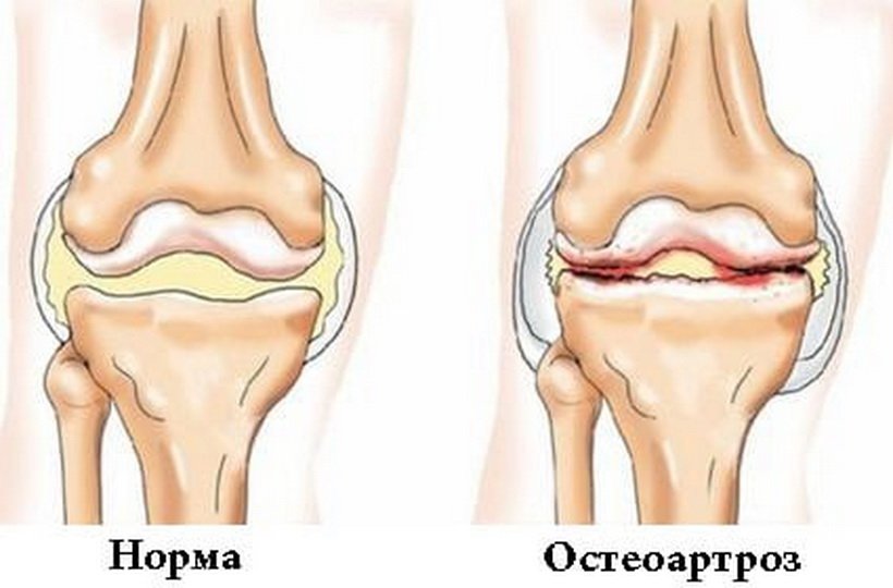Как распознать и вылечить остеопороз коленного сустава