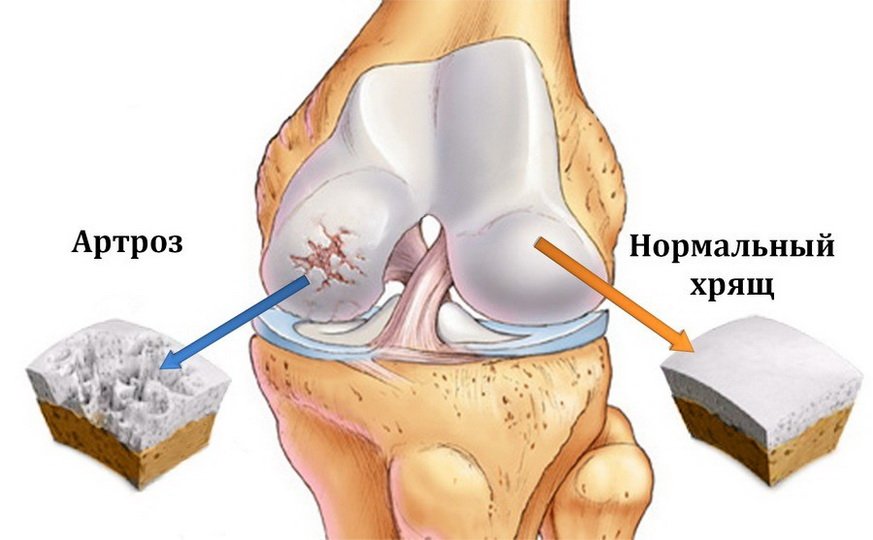 Методы лечения посттравматического артроза коленного сустава