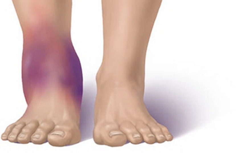 Отекают ноги в щиколотках и болят: полный обзор причин, лечение