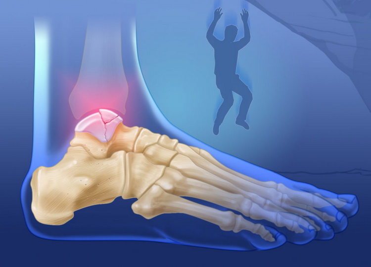 Симптомы и методы лечения трещины в костях ног