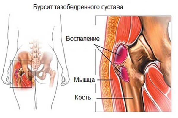 Симптомы бурсита тазобедренного сустава и способы его лечения