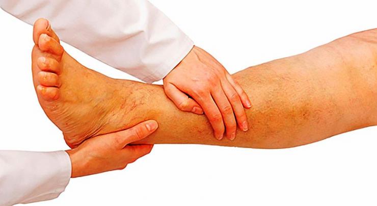 Симптомы и лечение артериопатии нижних конечностей