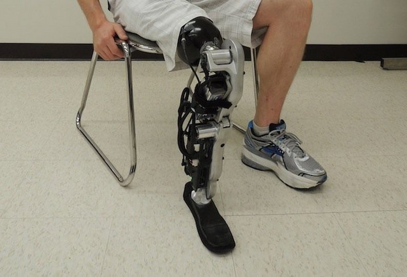 Реабилитации после ампутации ноги выше колена