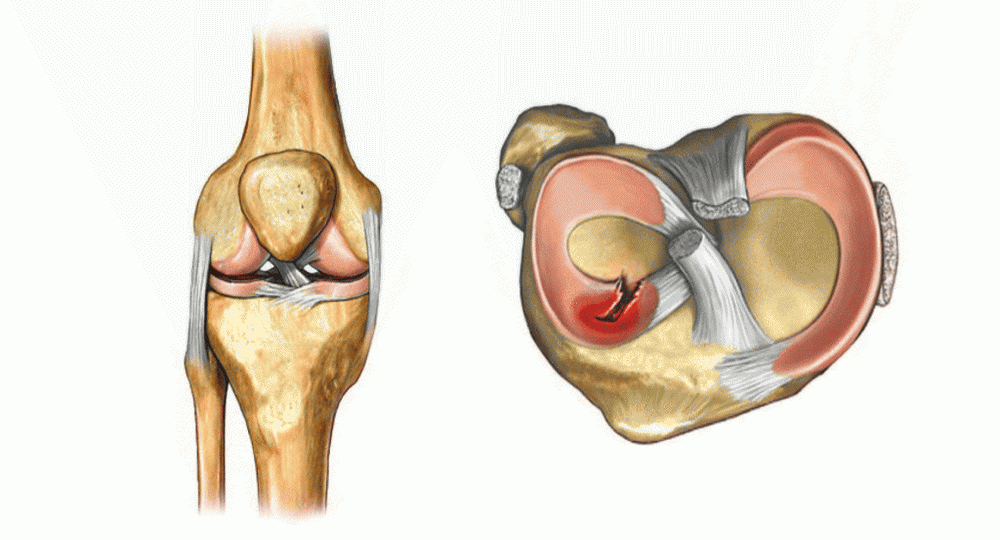 Разрыв мениска, растяжение связок коленного сустава: коды МКБ-10