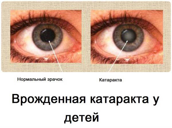 нормальный зрачок и катаракта