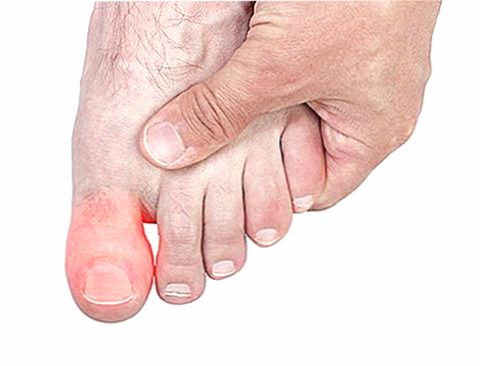 Как лечить синяки под ногтями больших пальцев ног? thumbnail