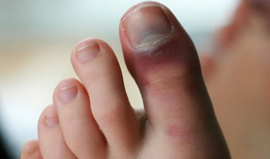Чем лечить ушиб пальца на ноге?