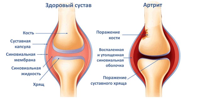 Здоровый сустав и сустав, пораженный артритом