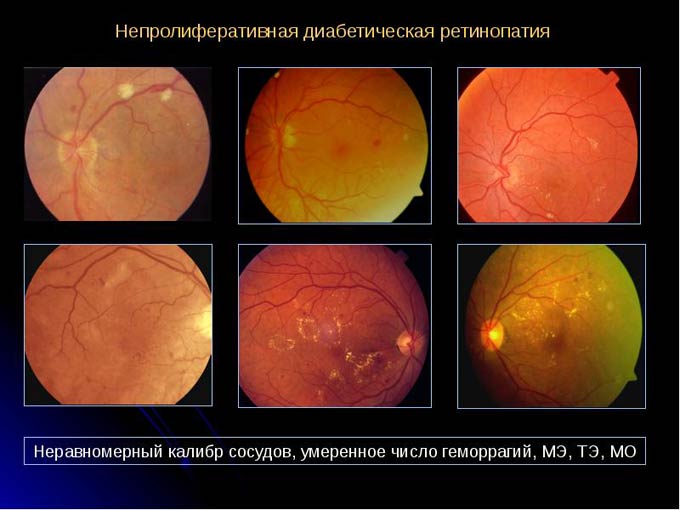 непролиферативная диабетическая ретинопатия