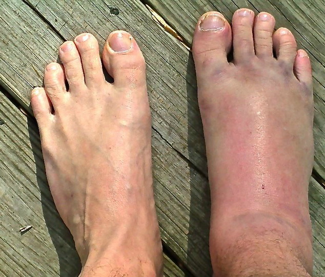 Почему опухают ноги в районе стопы у женщин, лечение отеков