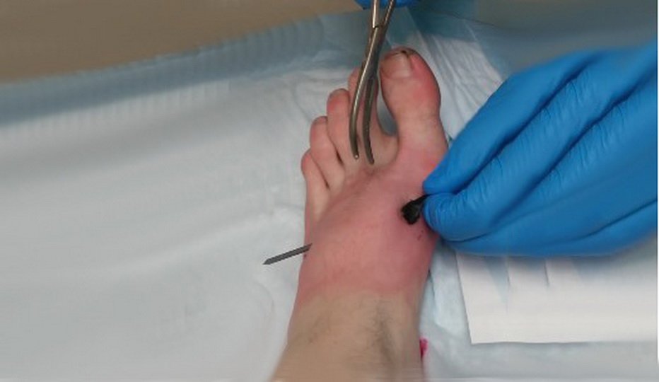 Лечение прокола ноги ржавым гвоздем