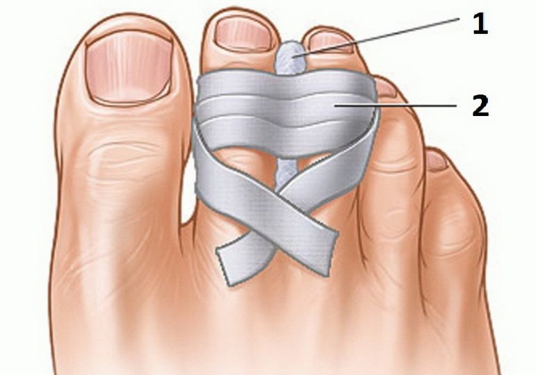 Чем лечить ушиб пальца на ноге?