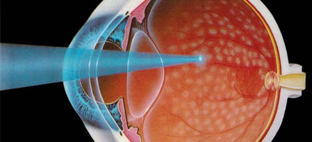 лазерная коагуляция сетчатки глаза