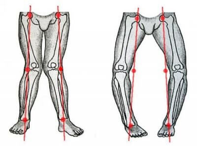 Лечение и профилактика варусной деформации коленных суставов