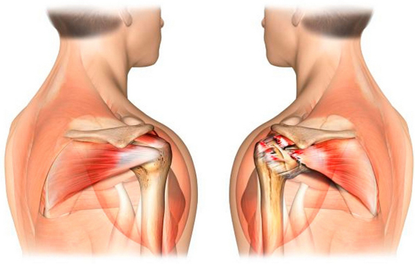 Разрыв сухожилий плеча