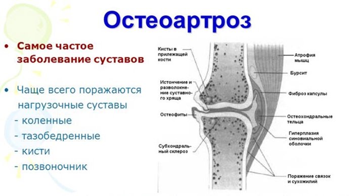 Проявления остеоартроза