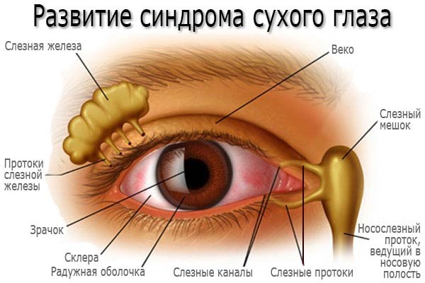 развитие синдрома сухого глаза