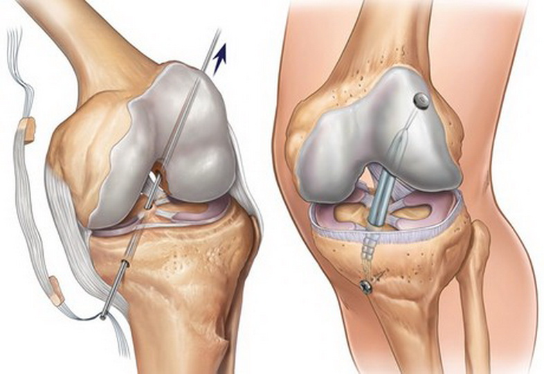 Лечение разрыва мениска коленного. Разрыв ПКС коленного сустава. ПКС (передняя крестообразная связка). Отрыв крестообразной связки колена. Операция пластика ПКС коленного сустава.