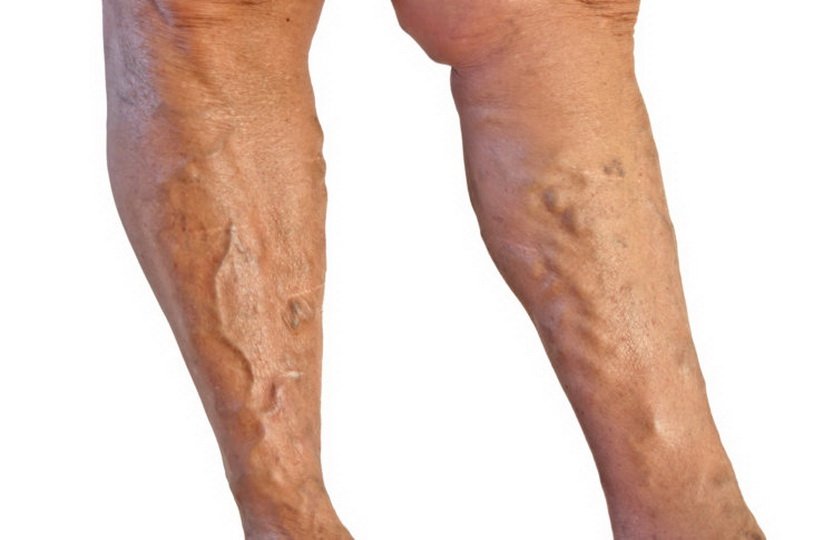 Причины шишек на ноге под кожей