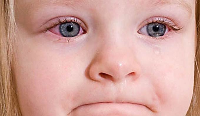 лечение аллергического конъюнктивита у детей