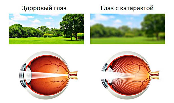 зрение при катаракте