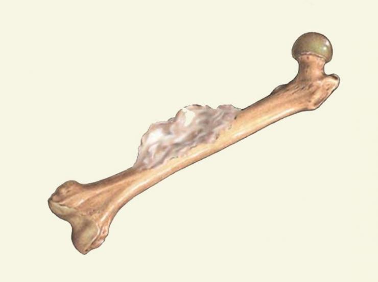 Симптомы, диагностика и лечение эностоза бедренной кости