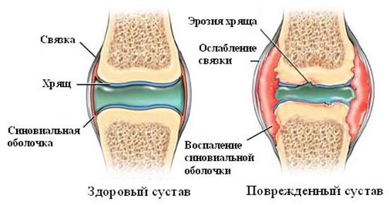 Лечение детского артрита коленного сустава