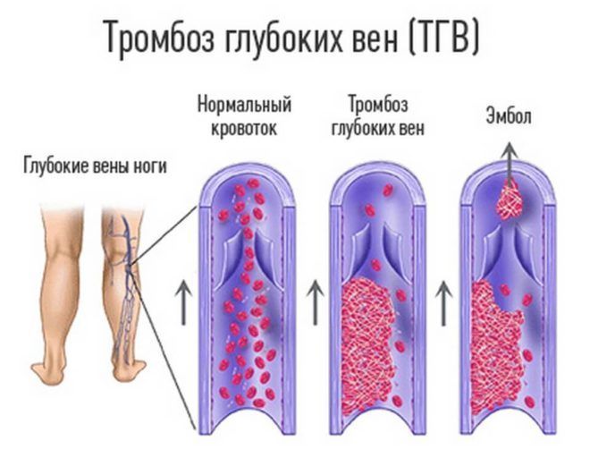 Классификация и лечение флеботромбоза глубоких вен ног