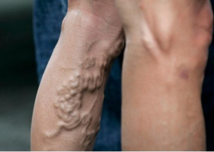 Опасные последствия варикоза на ногах у женщин и мужчин