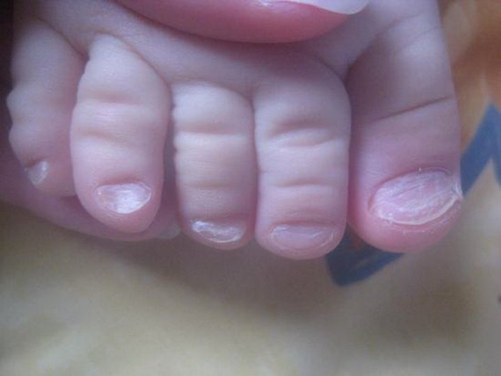 Лечение грибка ногтей у детей