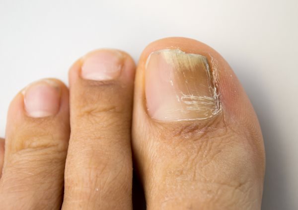 Лечение утолщения ногтя на большом пальце ноги