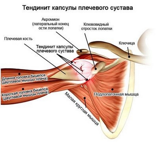 Тенденит плечевого сустава