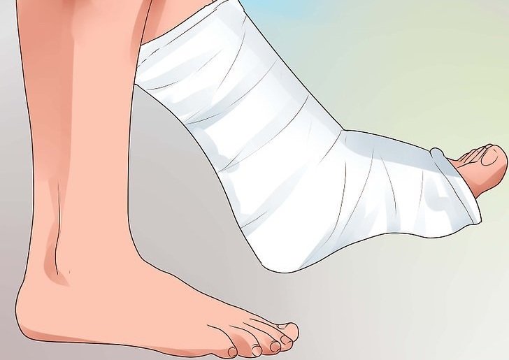 Признаки и лечение перелома ноги