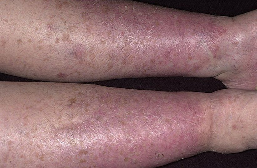 Лечение варикозного дерматита ног
