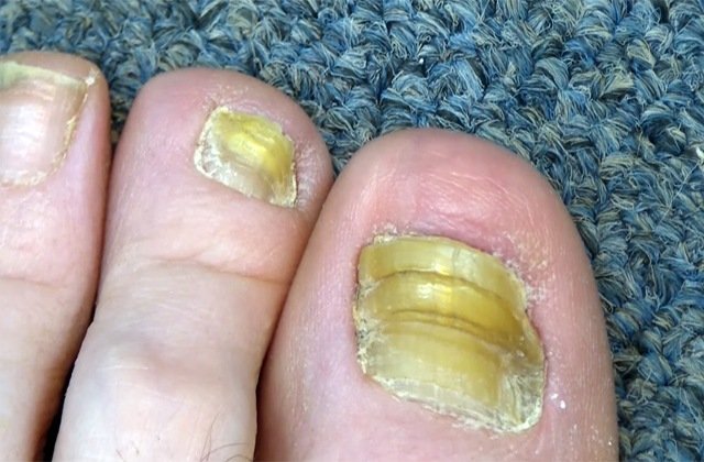 Пути заражения грибком ногтей на ногах