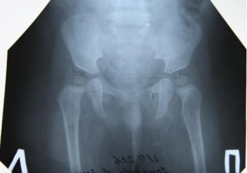 Расшифровка рентгена тазобедренных суставов