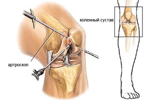 Особенности проведения артроскопии колена