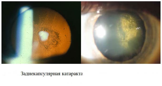 заднекапсулярная катаракта